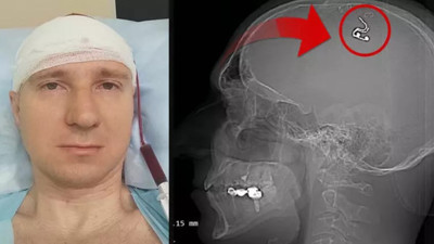 Nalburdan aldığı matkapla kafatasını deldi ölümden döndü. Operasyonun arkasındaki sebep duyanları şok etti
