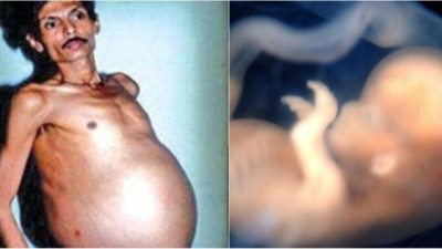 İkiz kardeşini 36 Yıl boyunca karnında taşıyan adamın sıra dışı hikayesini öğrenince şok olacaksınız