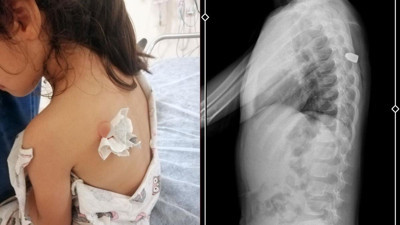 6 yaşındaki Meliha sırtını ‘böcek ısırdı’ sanıyor ama maganda kurşunu bu kez ona isabet etti