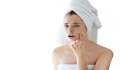 Sivilce lekelerini geçiren şifalı bitkiler ortaya çıktı