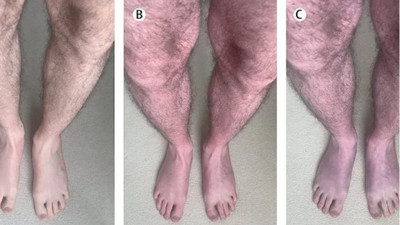 Bilim insanları uzun koronanın yeni belirtisini keşfetti. Uzmanlar uyardı