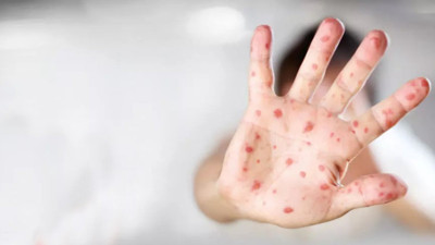 Sağlık Bakanlığı'ndan ‘kızamık’ alarmı. 81 ile yazı gönderildi