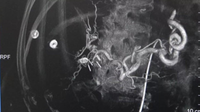 Kanserle mücadelede yeni silah