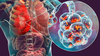 Polonya'da lejyonella bakterisi alarmı. 7 kişi öldü