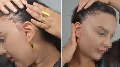 'Badem göz' ameliyatı faciaya yol açtı. 'İnanılmaz acılar çektim, evde günlerce ağladım'