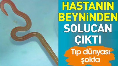 Hastanın beyninden solucan çıktı. Tıp dünyası şokta