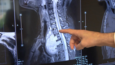 Portakal büyüklüğündeki tümöre başarılı operasyon