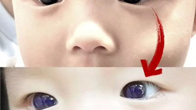 Bebeğe içirilen korona ilacı göz rengini değiştirdi. Çözümü bulan anne doktorlara talimatı verdi