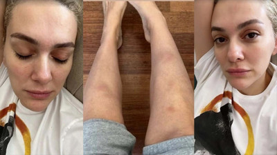 Bergüzar Korel moraran vücudunu paylaştı! Dayanamadı yaşadıklarını anlattı