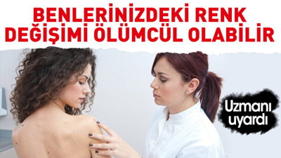 Uzmanı uyardı. Benlerinizdeki renk değişimi ölümcül olabilir