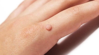 Rüyada siğil görmek ne demek? Rüyada siğil görmek neye işaret?