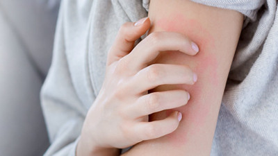 Uyuz hastalığı nasıl bulaşır? Uyuz belirtileri neler?