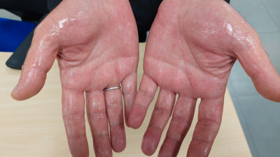 Elleriniz böyle olursa dikkat