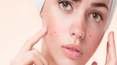 Akne ve lekeye hangi besinler iyi gelir