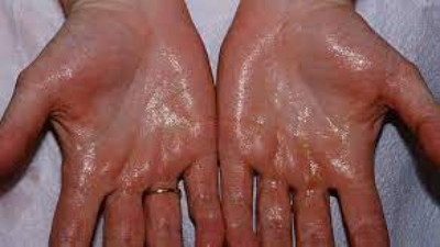 Aşırı terleme ölümcül bir hastalığın belirtisi mi