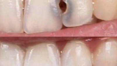 Dişlerinize ne yaparsanız çürümez