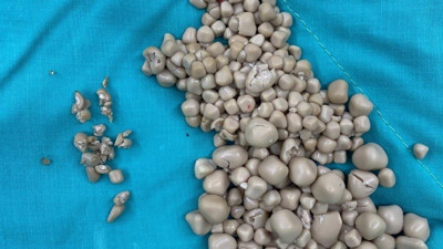 Sırt ağrısıyla gitti. 300 taş çıkarıldı