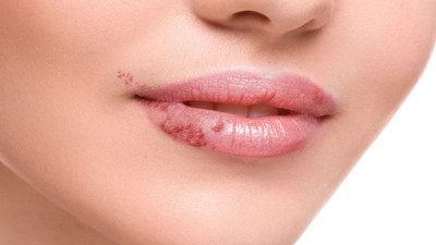 Dudak Uçuğuna ne yapmalı? (13 Aralık 2023)