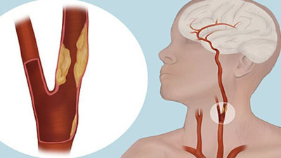 O damar asla tıkanmamalı