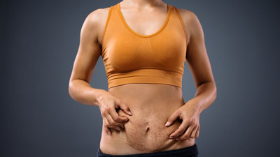 Doğum sonrası estetik yaptırmak yanlış mı