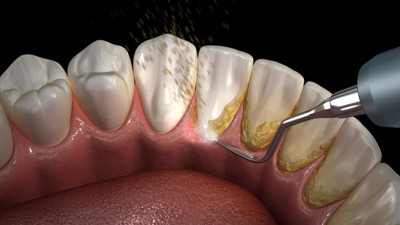 Evde diş taşlarından nasıl kurtulursunuz