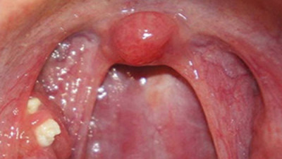 Ağız hijyeninin bozulması nelere yol açar (09 Ocak 2024)
