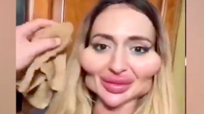 Estetik bağımlısı kadının son hali 'yok artık' dedirtti