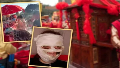 Sprey gerdek gecesi taze gelini yaktı. Yüzü tanınmaz hale geldi