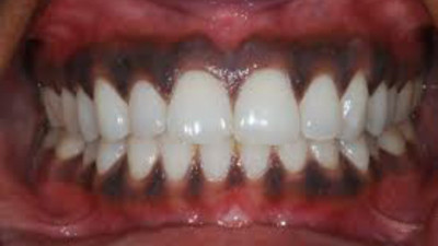 Hemen bir ayna bulup diş etlerinize bakın