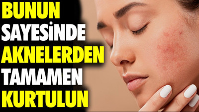 Bunun sayesinde aknelerinizden tamamen kurtulun