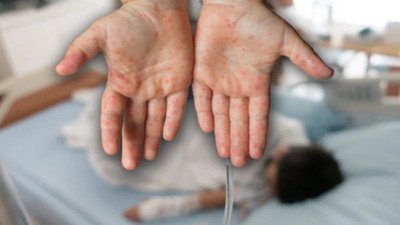 Yunanistan kızamık vakalarına karşı önlem aldı