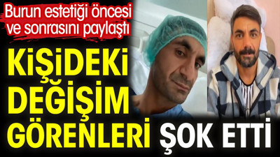 Burun estetiği öncesi ve sonrasını paylaştı. Kişideki değişim görenleri şok etti
