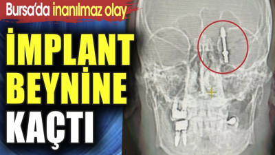 İmplant beynine kaçtı. Bursa'da inanılmaz olay