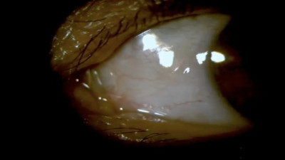 Lensini düşürdüğünü sandı. Göz doktoruna gidince şaşırtıcı gerçek ortaya çıktı