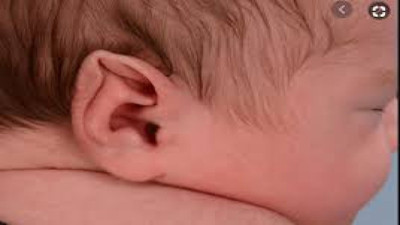 Bebeklerde görülen kulaktaki şekil bozukluğuna kritik öneri. Uzmanlar açıkladı