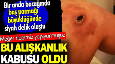 Bu alışkanlık kabusu oldu. Bir anda bacağında baş parmağı büyüklüğünde siyah delik oluştu