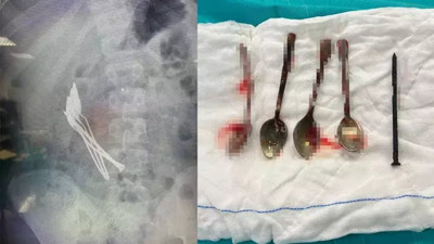 Kayseri’de doktorları hayrete düşüren olay! Çocuğun midesinden 4 kaşık ve 1 çivi çıktı