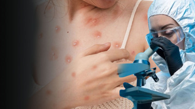 Maymun çiçeğinden daha tehlikeli! Vaka sayısı korkuttu