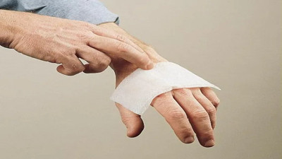 Yanık tedavisinde yapılan hatalarla ilgili uzmanlardan kritik uyarılar