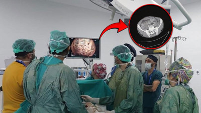 Katı gıdaları yedikten sonra kusuyordu! 10 kattan fazla büyüyen midesi doktorları bile şaşırttı