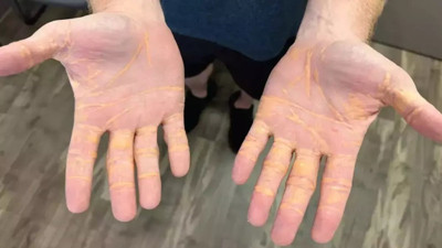 Diyetlerin yan etkileri ortraya çıktı! Uzmanlar açıkladı