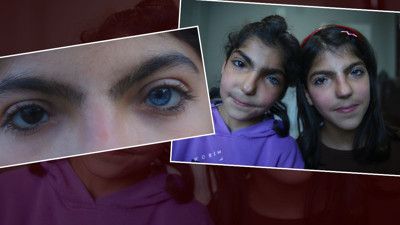 İki kız kardeşin göz renkleri görenleri şaşırttı