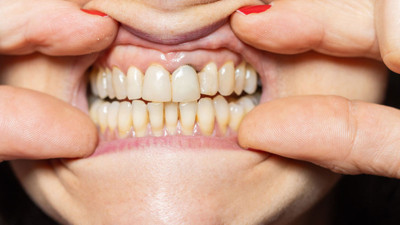 Uzmanı açıkladı: İleri diş eti hastalığı kalp krizi riskini artırıyor!