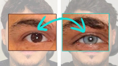 Göz rengi değiştirme ameliyatlarının riskleri ve uzman görüşleri