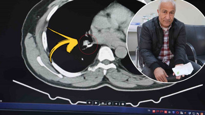 Öksürük şikayetiyle gitmişti: 1,5 yıl astım tedavisi gördü, gerçek bambaşka çıktı