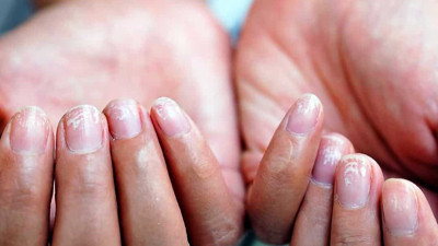 Tırnaklarda görülen belirtiler ve ciddi hastalıklar! Uzmanlardan uyarılar