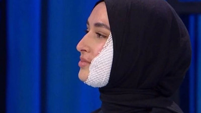 MasterChef Beyza aylar sonra yüzünün yanık halini paylaştı!