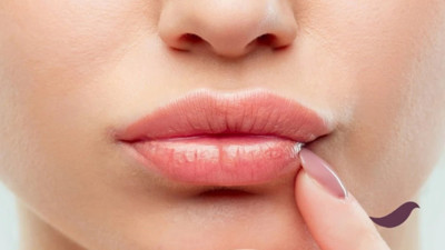 Dudak dolgusundaki hatalar! Uzmanlar uyardı