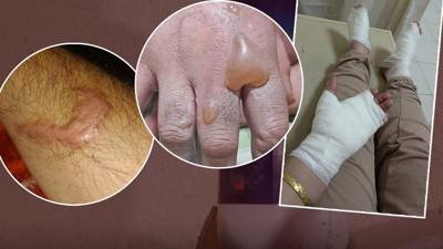 Lavabo açıcı adeta bomba gibi patladı! İki kardeşin vücudu yandı