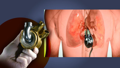 Tıp tarihinde devrim! Kalp nakli olana kadar yapay kalp ile aylarca yaşadı